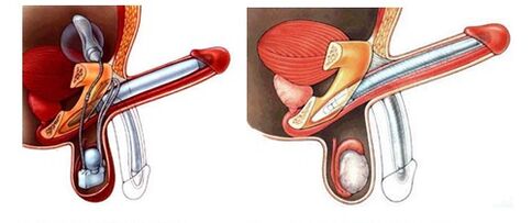 Şişirilebilir protezli (solda) ve plastikli (sağda) penil protez