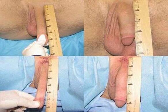büyütme ameliyatı sonrası penis ölçümü