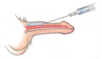 Penise hacim kazandıran hyaluronik asit enjeksiyonu